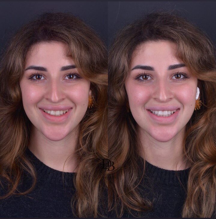 Счастливая пациентка после отбеливания зубов у доктора Бородиной